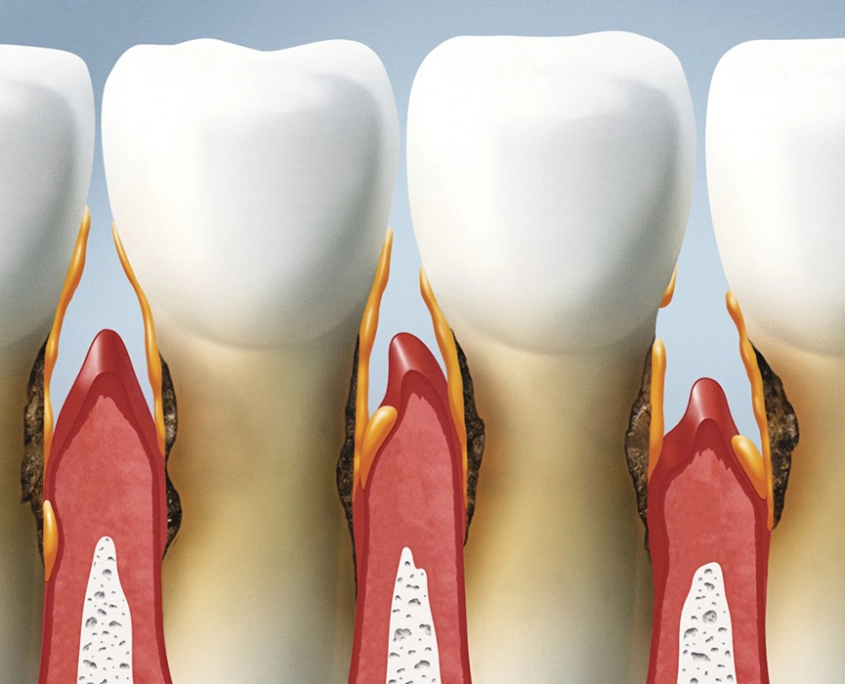 Periodontitis therapy at the dentist