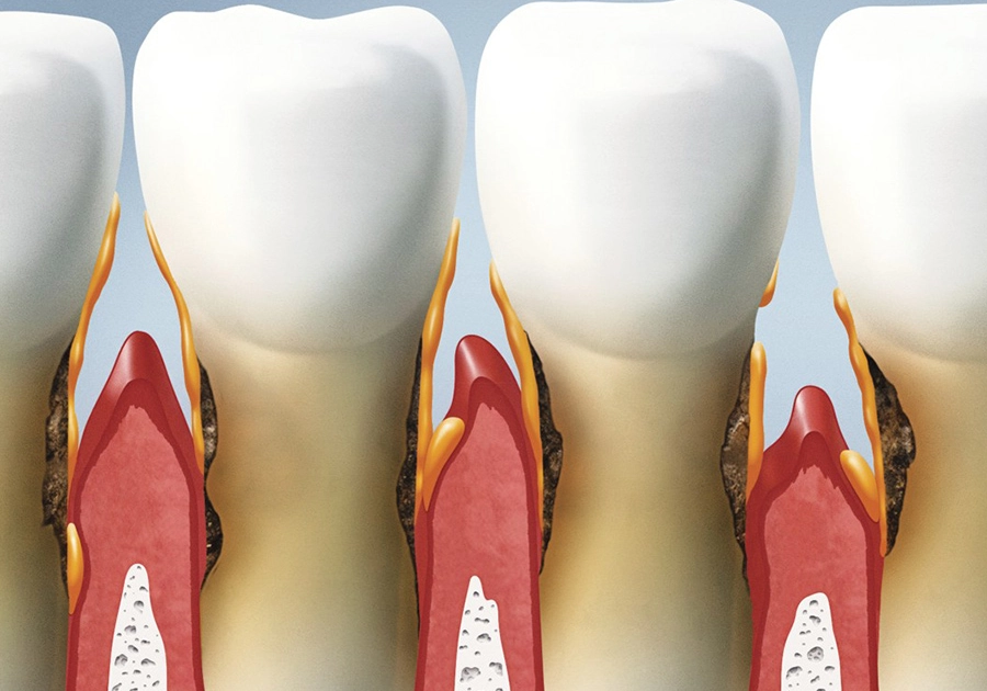 Parodontitis-Therapie beim Zahnarzt