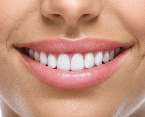 Veneers (Keramik-Schalen)