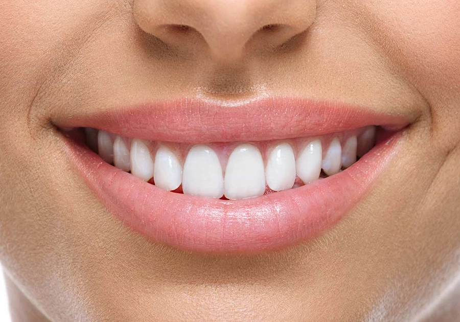 Schöne Zähne durch Veneers vom Zahnarzt