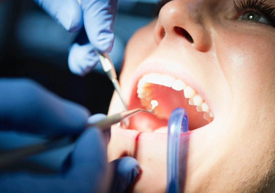 Insertion of tooth colored filling by dentist