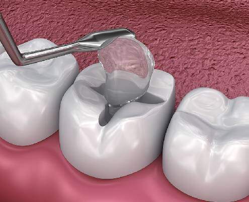 Plastic & Glass ionomer fillings