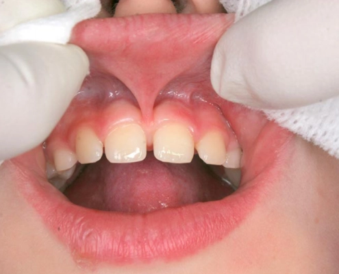 Correction of the labial frenulum