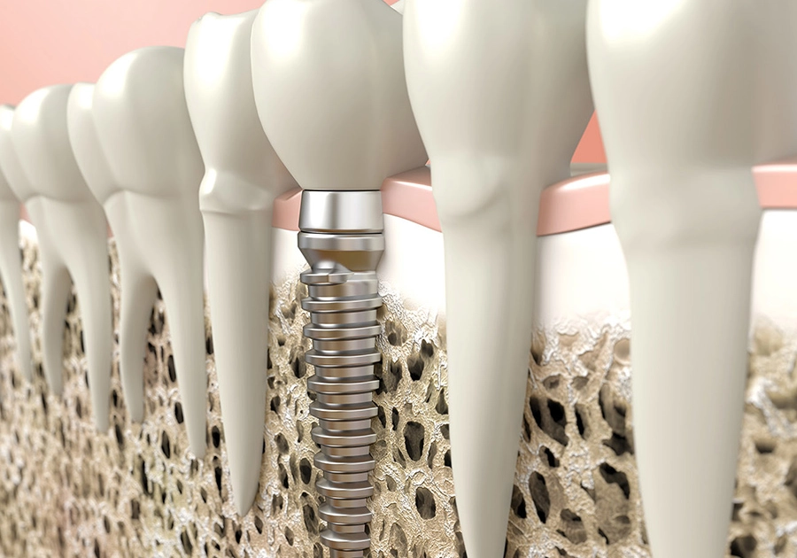 High quality tooth replacement with dental implants from the dentist